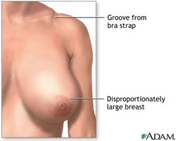 Breast Reduction Beverly Hills